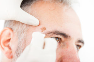 A man with facial skin cancer before Mohs surgery.